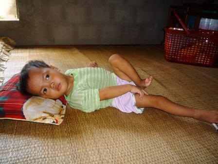 Sự sống mong manh của bé 2 tuổi bị nhiễm trùng máu    - 1