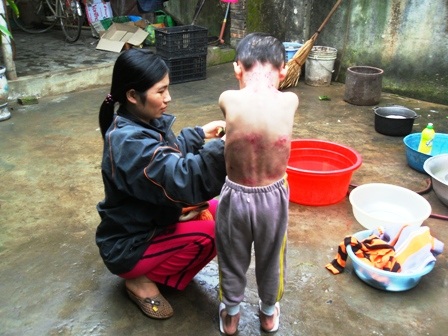 Món quà đầu xuân đến với cháu bé bị ly thượng bì bóng nước   - 1