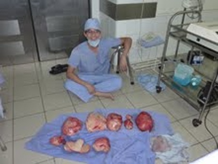 Các khối u sau khi được cắt bỏ.