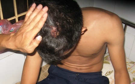 Bị khối bê tông đập vào đầu khiến anh Dương phải khâu nhiều múi trên đầu.