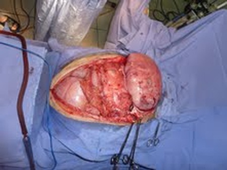 Các khối u lớn xuất hiện.