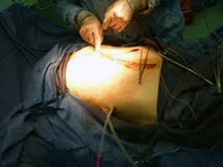 Khâu lại vết mổ.