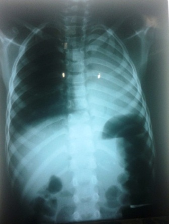 Hình ảnh chụp X-Quang phổi cháu Hào.