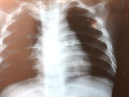 Hình ảnh chụp X- quang phổi bệnh nhi.
