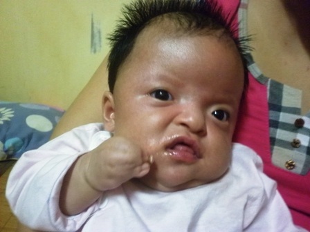 Bé Bảo Trâm đang mắc hội chứng Apert.