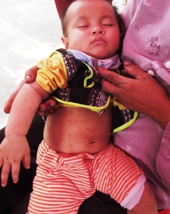  Cháu Nguyễn Văn Thiên lúc mới sinh ra đã nổi mẩn đỏ khắp người.