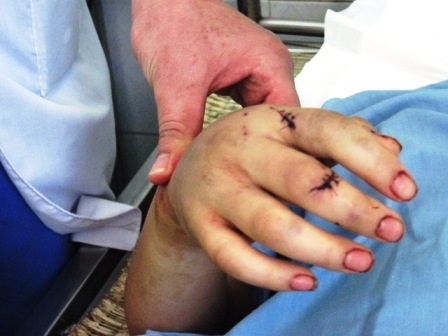 Những vết chém ở tay chị M.