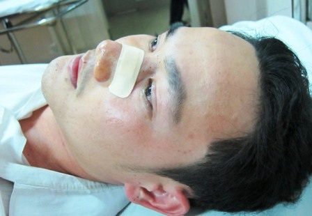 Một thanh niên gãy sống mũi sau khi va chạm với CSGT - 1