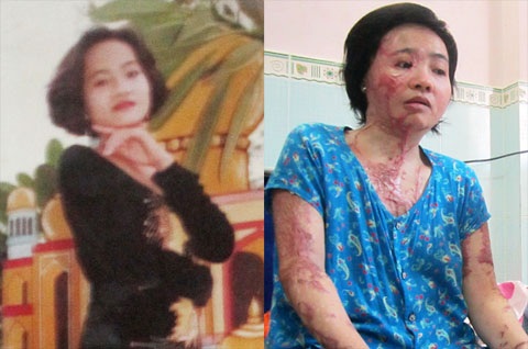 Chị Xuân trước và sau thời điểm bị hàng xóm tạt axit
