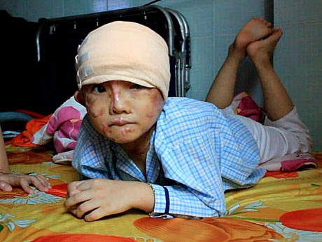 Khuôn mặt biến dạng do axit của bé Bảo