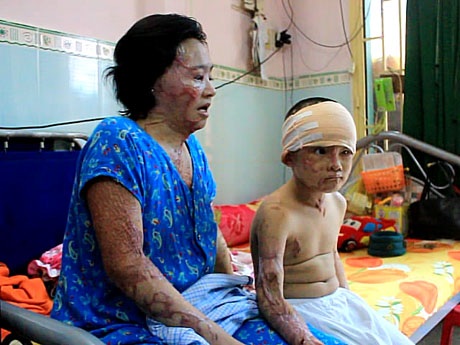 Hai mẹ con chị Xuân bị axit tàn phá, hủy hoại cơ thể