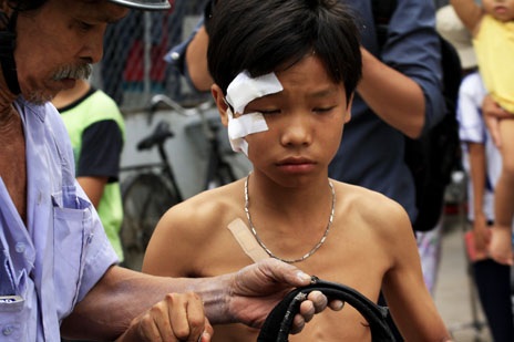 Nổ tung nhà trọ, 5 người bị thương - 4 Em Đạt bị thương vùng mặt sau vụ nổ