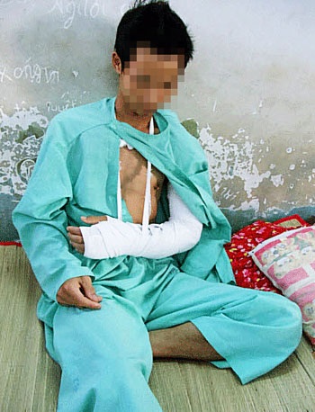 Đề nghị truy tố nhóm chém lìa tay một thanh niên cướp iphone “rởm” - 2 Nạn nhân Đ. bị băng cướp trên chém gần đứt lìa cánh tay