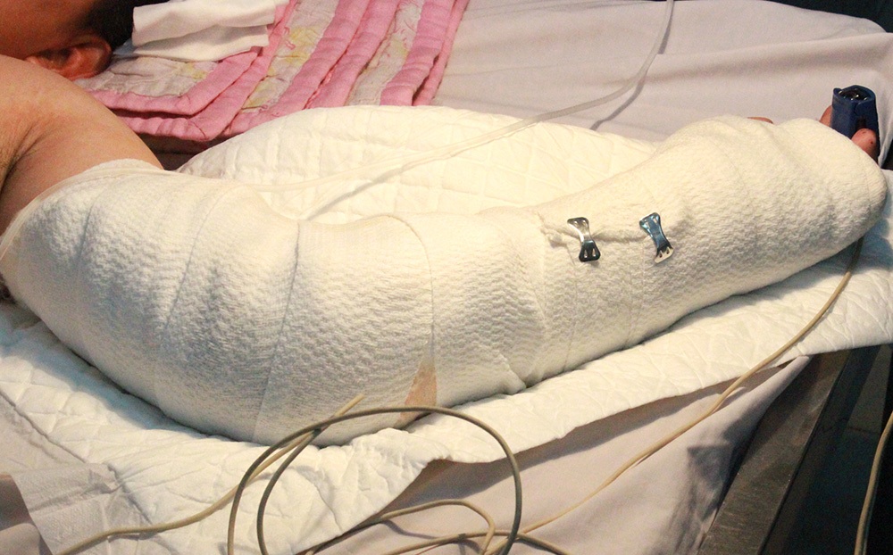 Nối thành công cánh tay bị đứt lìa - 2 Cánh tay của nguyễn thái sơn được nối thành công