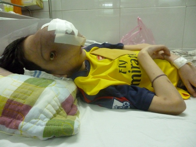 Khối u khiến cậu bé 4 năm sống trong đau đớn, khổ cực