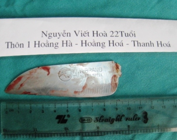 Phần dao bị gãy được các bác sỹ lấy ra từ người bệnh nhân (Ảnh: Nguyễn Thùy)