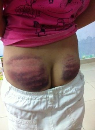 Làm rõ vụ học sinh lớp 4 bị thầy đánh bầm tím vì không thuộc bài - 1 Hình ảnh toàn bộ phần mông của bé V. bị bầm tím...