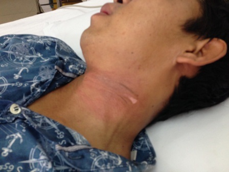 Vết dây điện cứa trên cổ nạn nhân Nguyễn Thanh Tùng