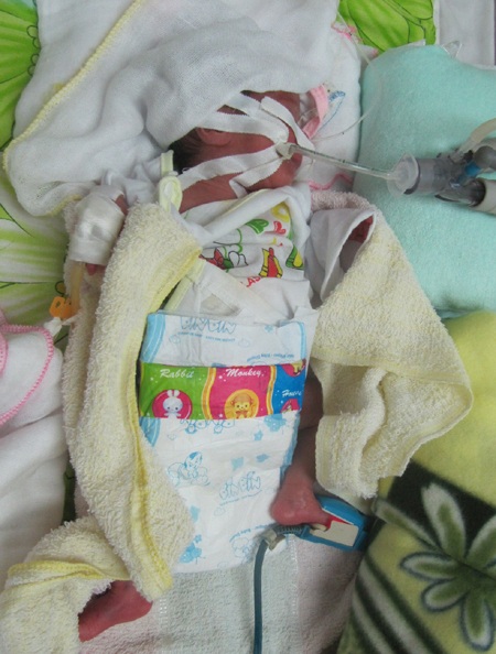 Kỳ tích của bé sơ sinh nặng... 6 lạng - 4 Kỳ tích của bé sơ sinh nặng... 6 lạng - 4