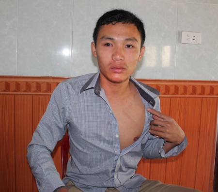 Trưởng Công an xã bị “tố” vô cớ đánh người - 2 Và vết bầm vẫn còn hằn trên ngực Lê Minh Anh sau 10 ngày