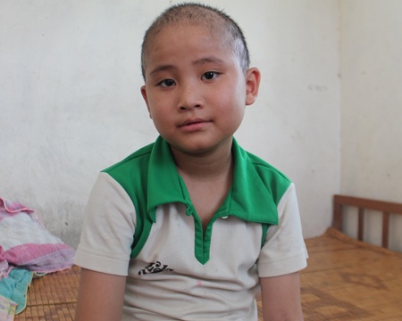 Ngô Quang Phúc với mái đầu đã rụng hết tóc do tác động của đợt hóa trị.