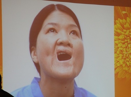 Gương mặt với phần miệng bị biến dạng của ca sĩ Thủy Tiên