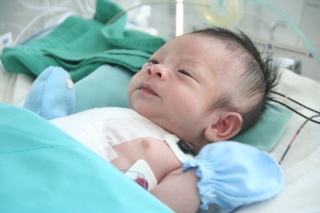 Cứu sống trẻ sơ sinh mắc bệnh tim hiếm gặp - 2 Cháu bé mới sinh vài ngày đã bị bệnh tim hiếm gặp chuyển vị đại động mạch