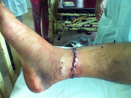 Cẳng chân bị đứt của bệnh nhân Quyết đã được nối thành công