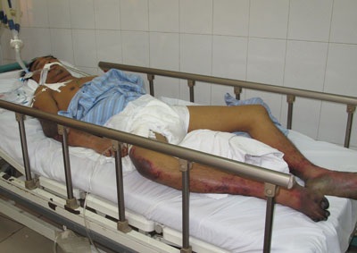 Gần 60% bệnh nhân mắc liên cầu khuẩn lợn có ăn tiết canh - 1