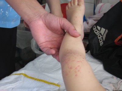 Miền Bắc: Có chủng vi-rút gây bệnh tay chân miệng nguy hiểm - 1