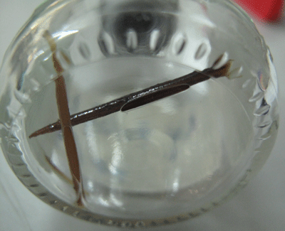 Mổ ruột thừa, điều trị gần 2 tháng vì nuốt phải tăm nhọn - 1