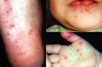 Nhận biết sớm bệnh tay chân miệng - 1 Nhận biết sớm bệnh tay chân miệng - 1