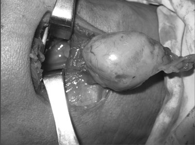 Cắt bỏ thành công khối u to chèn thành họng - 1 Cắt bỏ thành công khối u to chèn thành họng - 1