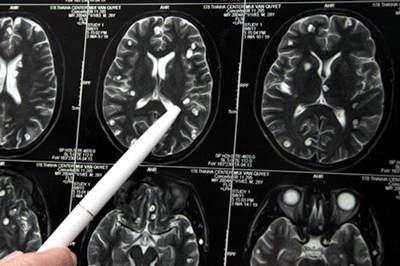 Lên cơn co giật, động kinh vì sán “làm tổ” trong não - 1