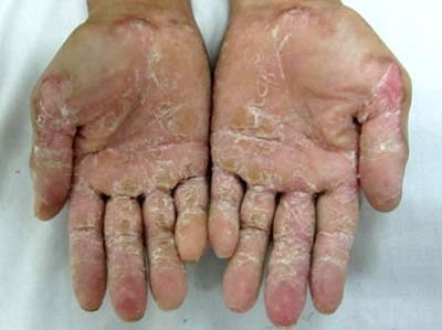 Tìm ra "bệnh da lạ" ở Quảng Ngãi - 1 Tìm ra "bệnh da lạ" ở Quảng Ngãi - 1