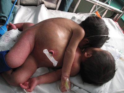 Chiều nay sẽ mổ tách cặp song sinh dính liền