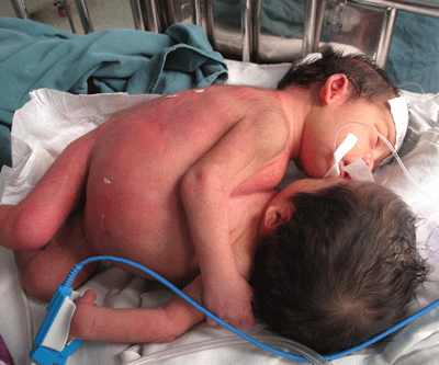 “Cặp song sinh dính nhau rất phức tạp”