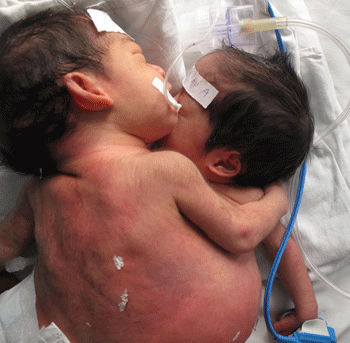 “Cặp song sinh dính nhau rất phức tạp”