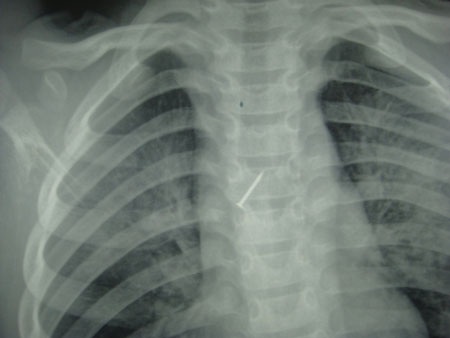 Đinh ghim găm vào phế quản bé trai 6 tuổi