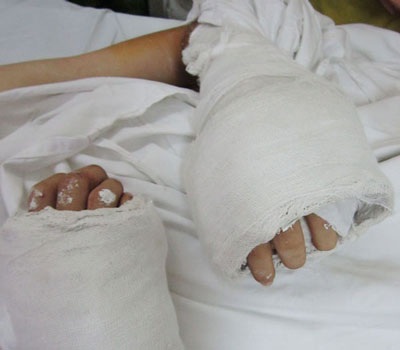 Nối thành công hai bàn tay đứt lìa - 1 Bàn tay của bệnh nhân sau hơn 12h được ghép đã có dấu hiệu sống lại. Ảnh: BS cung cấp.