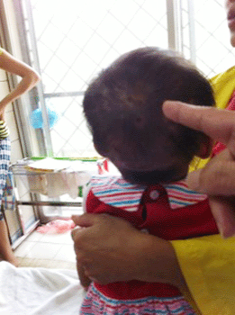 Các nốt ong đốt vẫn chưa lành trên đầu bệnh nhi