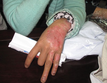 Người bệnh vẩy nến khốn khổ với “nốt hoa râm”, bong tróc toàn thân - 2 Với tổn thương này, một thời gian dài chị Hoàn đã bị mọi người xa lánh. Ảnh: H.Hải