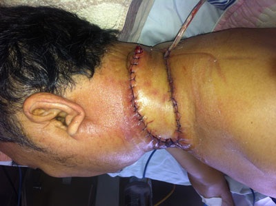 Suýt mất mạng vì đắp thuốc nam chữa u cổ - 2 Vùng cổ sau khi được làm sạch lớp loét, che phủ bằng vạt da lấy từ