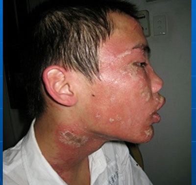 Sốt cao, sưng đau vì nọc độc kiến ba khoang - 1 Sốt cao, sưng đau vì nọc độc kiến ba khoang