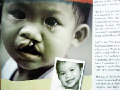 Phẫu thuật miễn phí cho trẻ sứt môi, hở hàm ếch