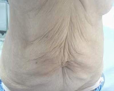 “Hồi xuân” cho một bệnh nhân nhão da hiếm gặp