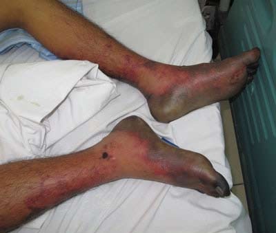 Ăn tiết canh, phải đón Tết ở bệnh viện - 1 Ăn tiết canh, phải đón Tết ở bệnh viện