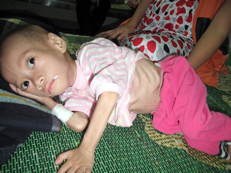 Bé Dũng trong tình trạng chỉ còn da bọc xương.