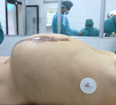 Phẫu thuật khối u “khủng” 14 kg trong bụng bệnh nhân - 1 Khối u khủng khiến bụng bà H như người mang bầu song sinh. Ảnh: BS cung cấp.