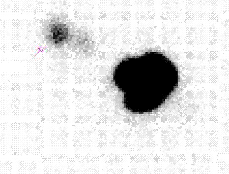 Phù “tay voi” sau nạo vét hạch ung thư vú - 1 Hình ảnh hạch cửa được pháp hiện nhờ phương pháp sử dụng đồng vị phóng xạ.